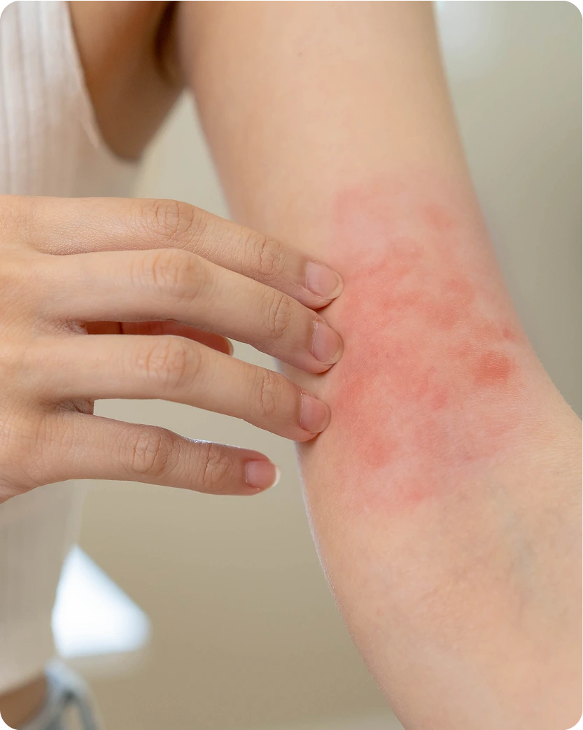What Is an Insect Sting Allergy Treatment San Mateo, CA Banner